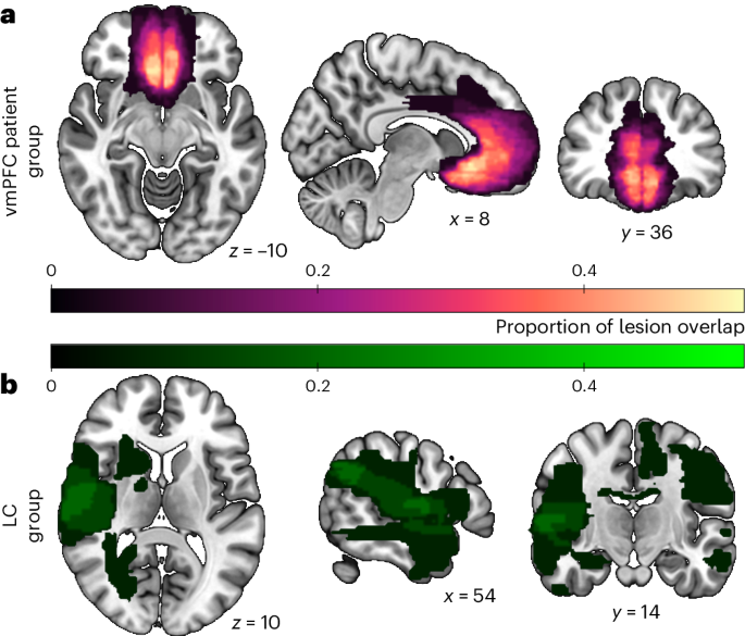 脳の損傷により、他者を助けるために必要な脳の一部が明らかになる(Brain damage reveals part of the brain necessary for helping others)