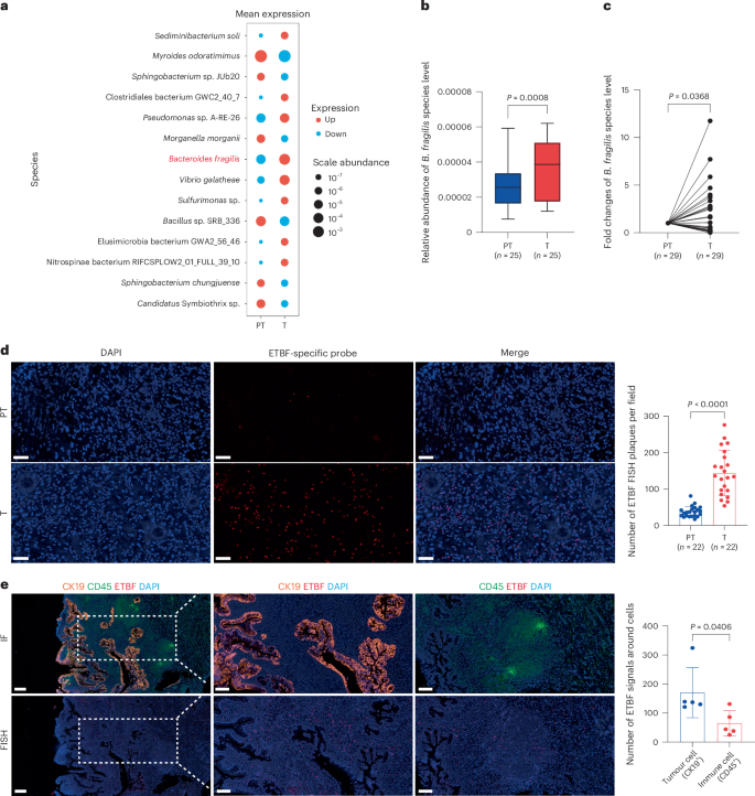 consent form for glutathione injection Bacteroides fragilis toxin promotes gall bladder cancer in mice