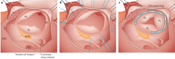 Successful first-in-man percutaneous transapical-transseptal Melody mitral  valve-in-ring implantation after complicated closure of a para-annular ring  leak | EuroIntervention