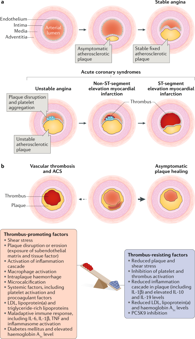 The Myth Of Stable Coronary Artery Disease Nature Reviews Cardiology