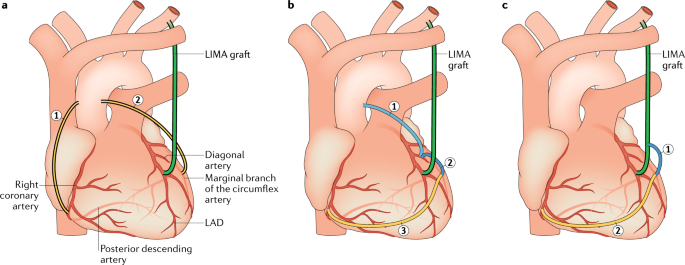 Download Saphenous Vein Grafts In Contemporary Coronary Artery Bypass Graft Surgery Nature Reviews Cardiology