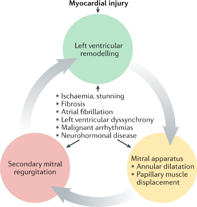 Mitral valve regurgitation: a disease with a wide spectrum of therapeutic  options | Nature Reviews Cardiology