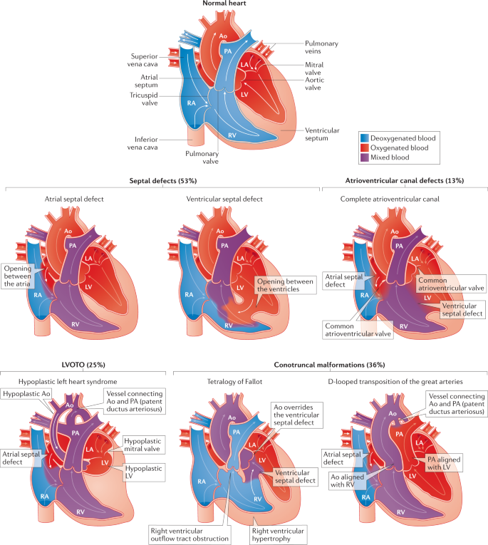 congenital heart disease