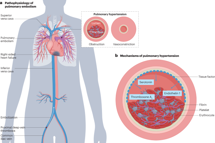 pulmonary embolism diagram
