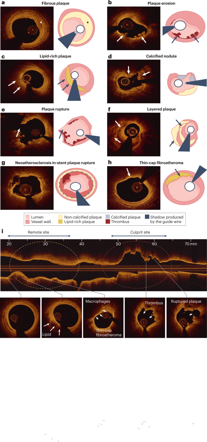 Frontiers  Characteristics and evaluation of atherosclerotic plaques: an  overview of state-of-the-art techniques