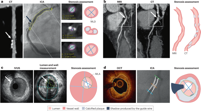 Fig. 4: Imaging modalities for the assessment of coronary stenosis.