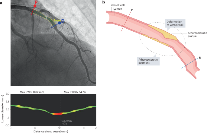Fig. 8: Representative example of coronary radial wall strain analysis.