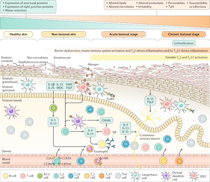 atopic dermatitis nature article