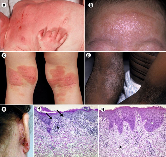 Atopic Dermatitis Nature Reviews Disease Primers