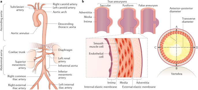 Abdominal Aortic Aneurysms Nature Reviews Disease Primers