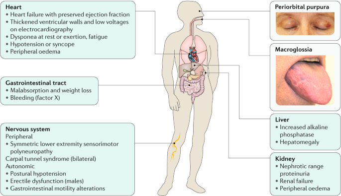 Systemic immunoglobulin light chain amyloidosis | Nature Reviews Disease  Primers