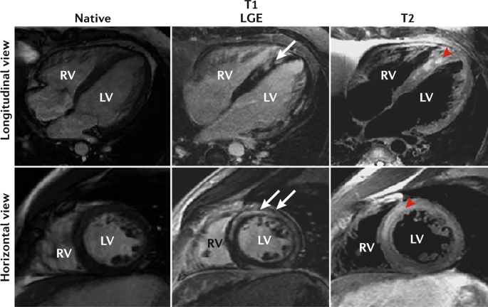 Frontiers  Multi-Modality Imaging in Dilated Cardiomyopathy: With a Focus  on the Role of Cardiac Magnetic Resonance