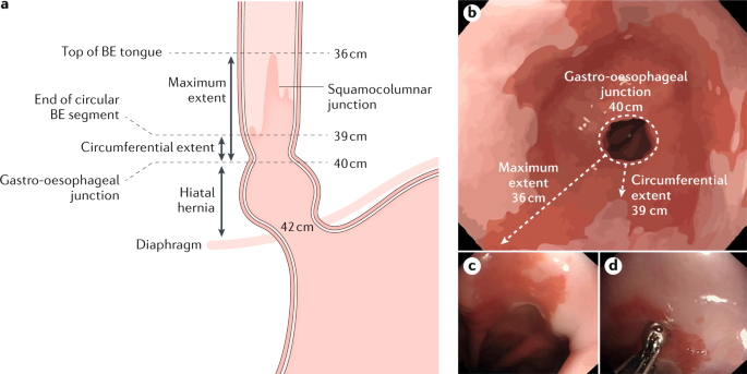 Barrett oesophagus | Nature Reviews Disease Primers