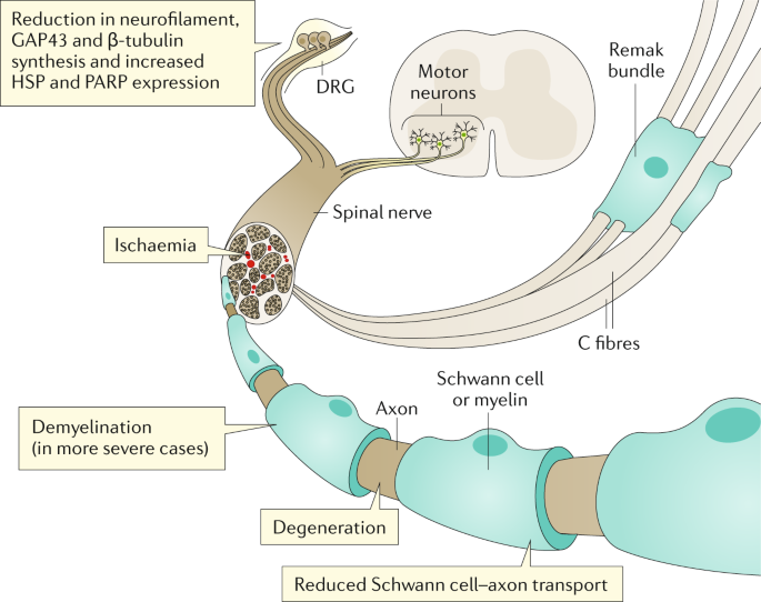 diabetic polyneuropathy review