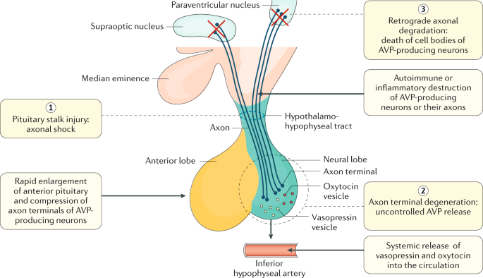 diabetes insipidus hypertension)