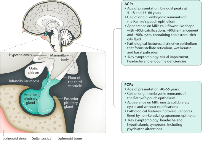 Craniopharyngioma Nature Reviews Disease Primers Craniopharyngioma Nature Reviews Disease Primers