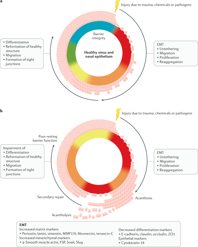 Staphylococcus aureus as a cause of refractory chronic rhinosinusitis