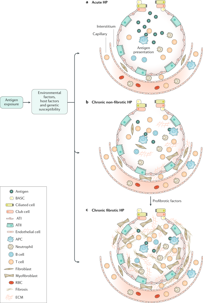 Hypersensitivity Pneumonitis Nature Reviews Disease Primers
