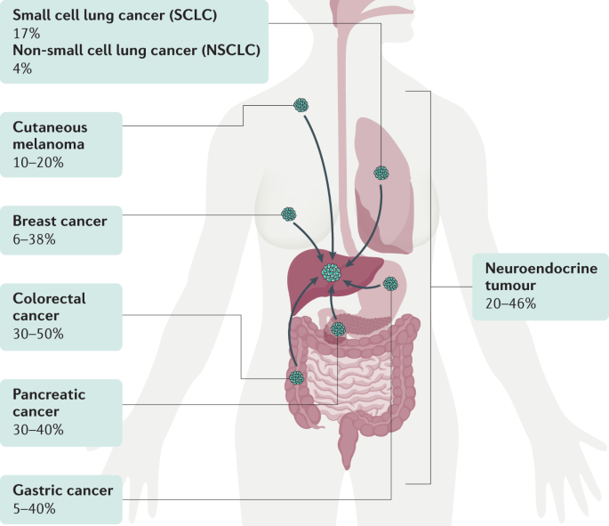 Liver Metastases | Nature Reviews Disease Primers