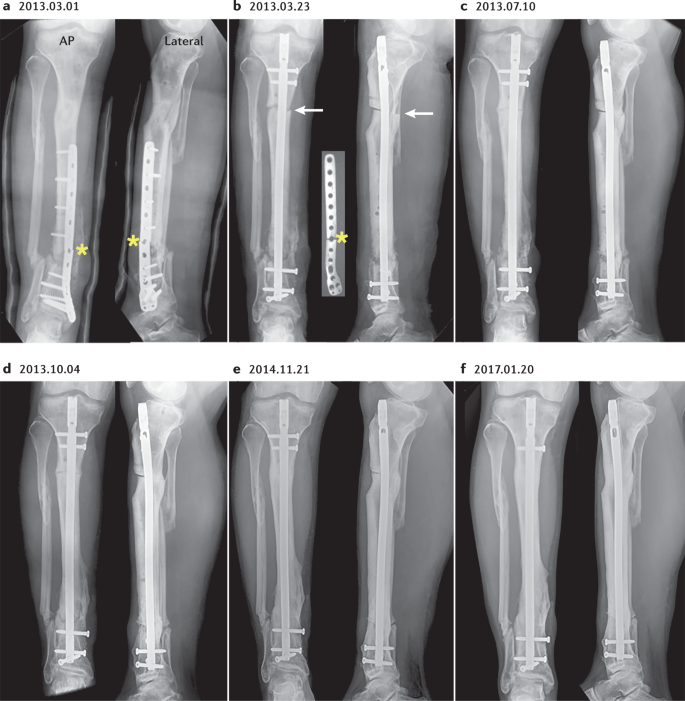 THE MANAGEMENT OF INFECTED NONUNION TIBIA SHAFT WITH ILIZAROV RING