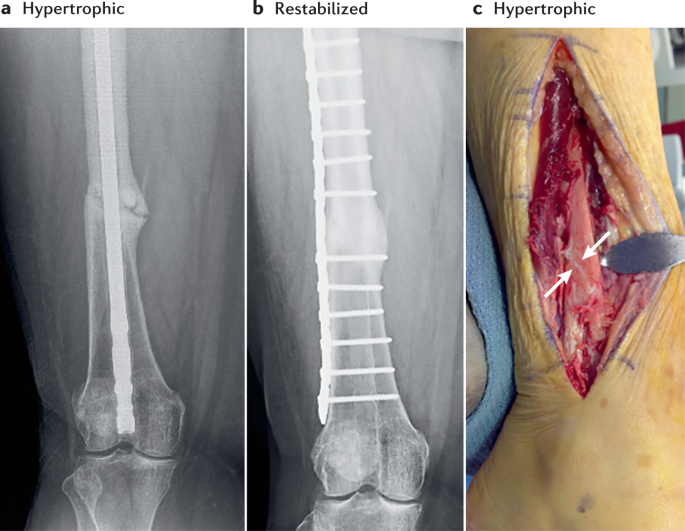 Non-union bone fractures | Nature Reviews Disease Primers