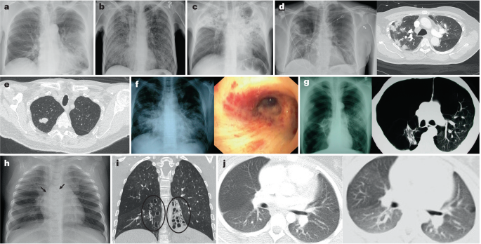 HIV-associated lung disease | Nature Reviews Disease Primers