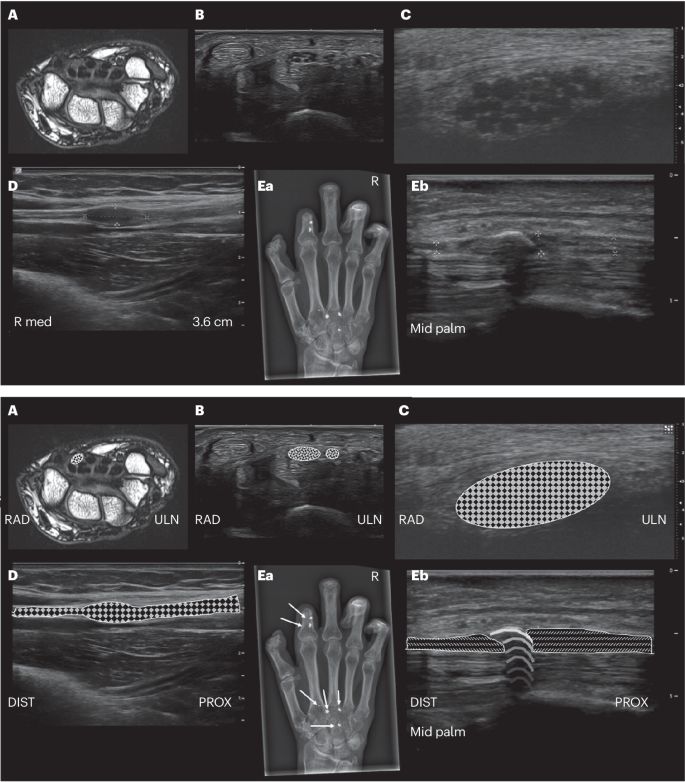 Carpal tunnel syndrome | Nature Reviews Disease Primers Carpal tunnel syndrome | Nature Reviews Disease Primers