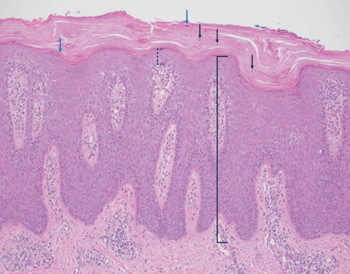 bpc-157 psoriasis evidence Psoriasis