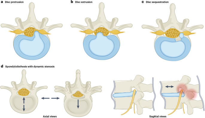 Intervertebral disc degeneration