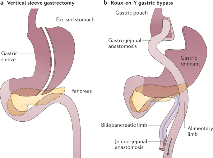 Potential Gut Brain Mechanisms Behind Adverse Mental Health Outcomes Of Bariatric Surgery Nature Reviews Endocrinology
