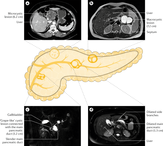 Diagnosis And Management Of Pancreatic Cystic Neoplasms Current Evidence And Guidelines Nature Reviews Gastroenterology Hepatology