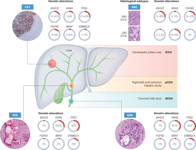 Fig. 1: Cholangiocarcinoma anatomical subtypes and their most frequent genetic alterations.