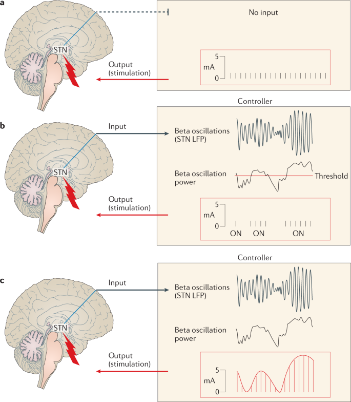 Biomarkers for closed-loop deep brain stimulation in Parkinson disease and  beyond | Nature Reviews Neurology