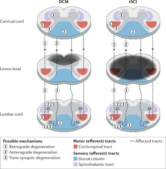 Traumatic And Nontraumatic Spinal Cord Injury Pathological Insights From Neuroimaging Nature Reviews Neurology