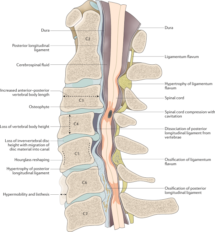 Degenerative Cervical Myelopathy Update And Future Directions Nature Reviews Neurology Degenerative Cervical Myelopathy Update And Future Directions Nature Reviews Neurology