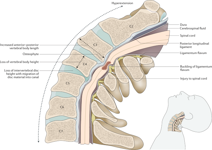 Degenerative Cervical Myelopathy Update And Future Directions Nature Reviews Neurology