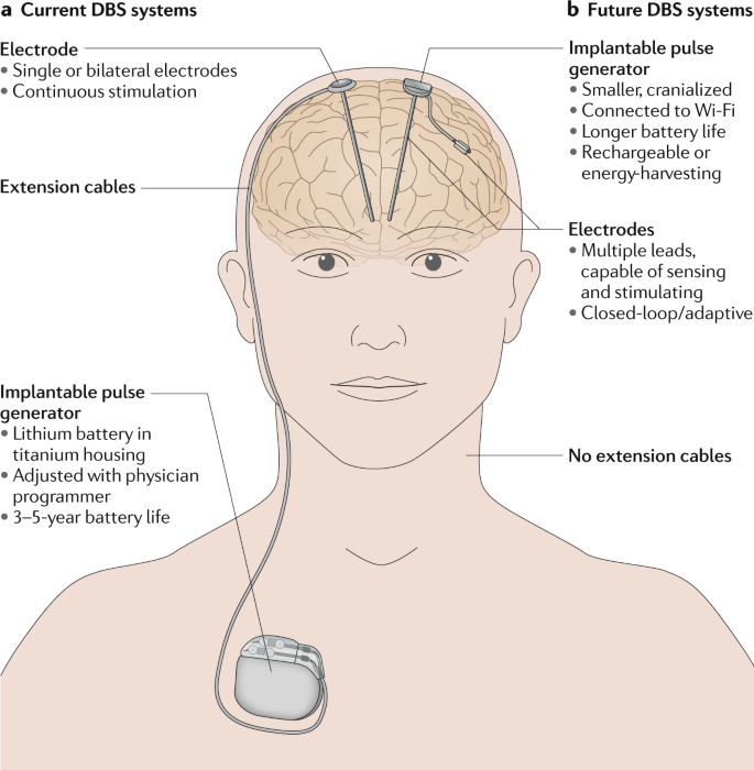 Technology of deep brain stimulation: current status and future directions  | Nature Reviews Neurology