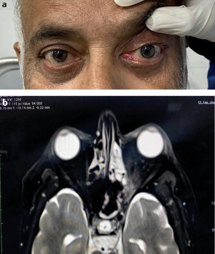 Neurological manifestations of rhino-oculo-cerebral mucormycosis in the COVID-19 era | Nature Reviews Neurology