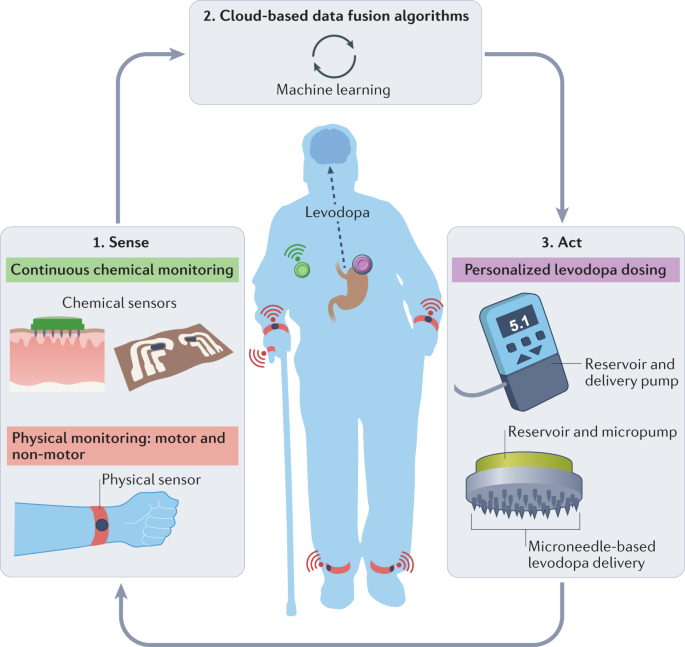 glutathione parkinson Parkinson's disease and glucose metabolism impairment | Translational  Neurodegeneration