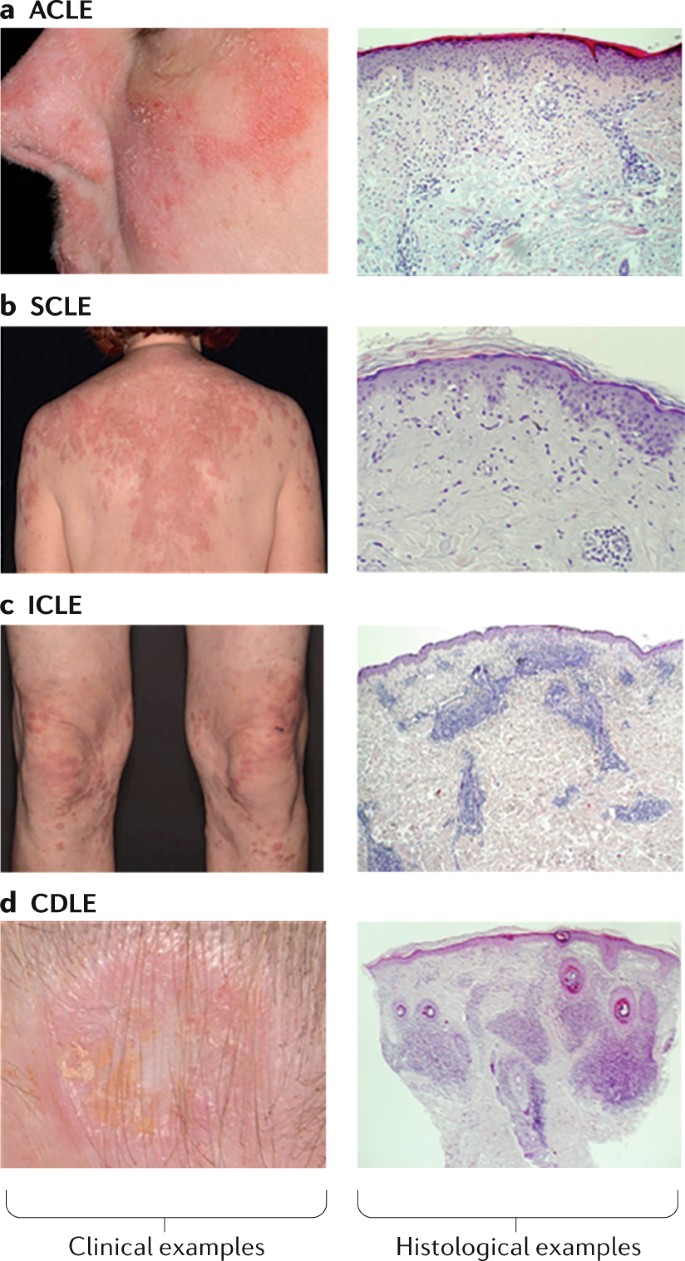 Cutaneous lupus erythematosus: new insights into pathogenesis and  therapeutic strategies | Nature Reviews Rheumatology