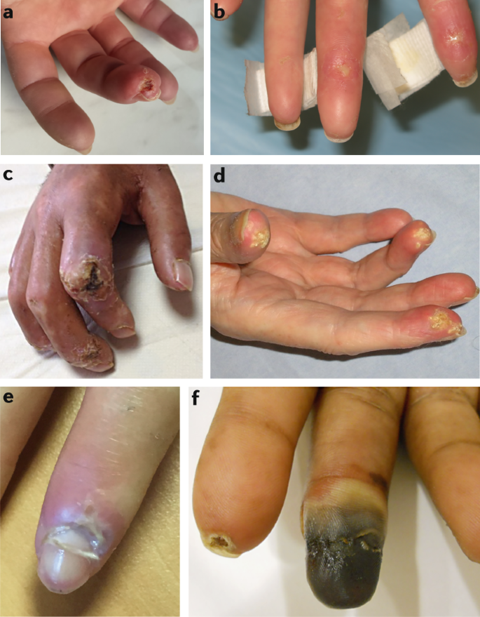 Raynaud phenomenon and digital ulcers in systemic sclerosis | Nature  Reviews Rheumatology