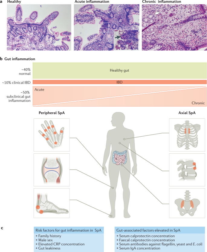 Revisiting The Gut Joint Axis Links Between Gut Inflammation And Spondyloarthritis Nature Reviews Rheumatology