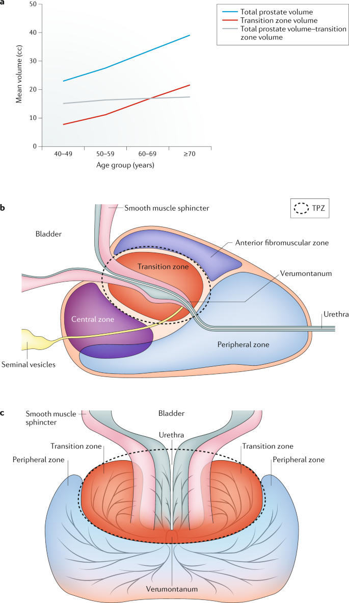 the development of human benign prostatic hyperplasia with age
