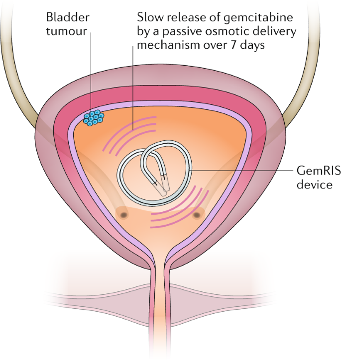 Intravesical Device Assisted Therapies For Non Muscle Invasive Bladder Cancer Nature Reviews Urology
