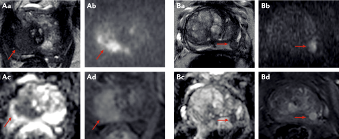 rmn prostata multiparametrica