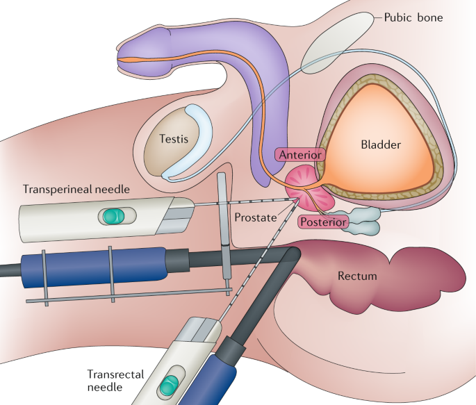 multiparametric mri prostate procedure krónikus prosztatitis milyen gyakran súlyosbít