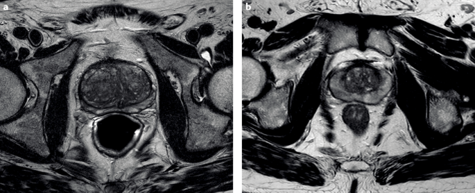 Normal prostate size radiology - Prostate exam what to expect