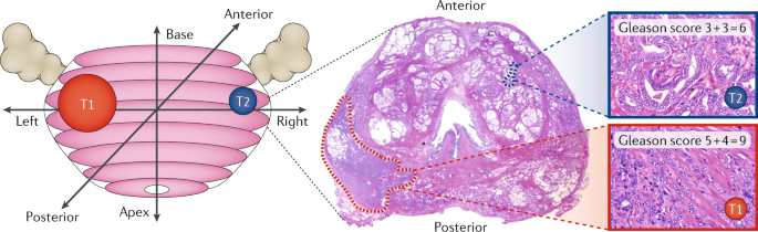 lehet hogy a prostatitis ha a fájdalom best prostate cancer surgeons uk