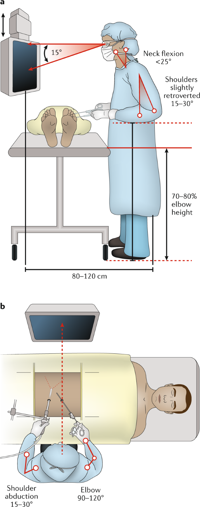 Surgical Ergonomics For Urologists A Practical Guide Nature Reviews Urology
