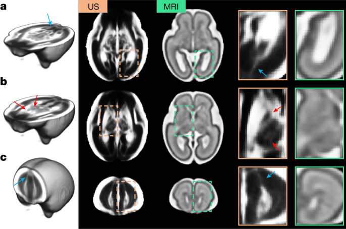 Fig. 2: Comparison between US and MRI atlases of the fetal brain.